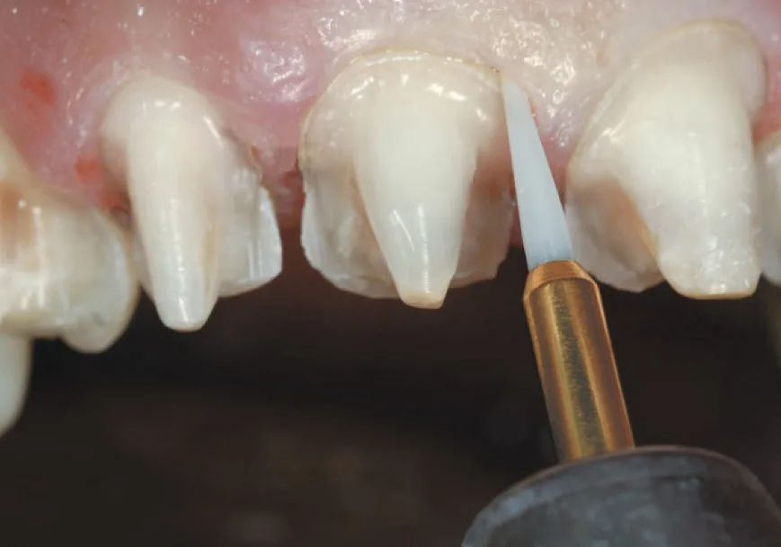 Soft Tissue Trimmer